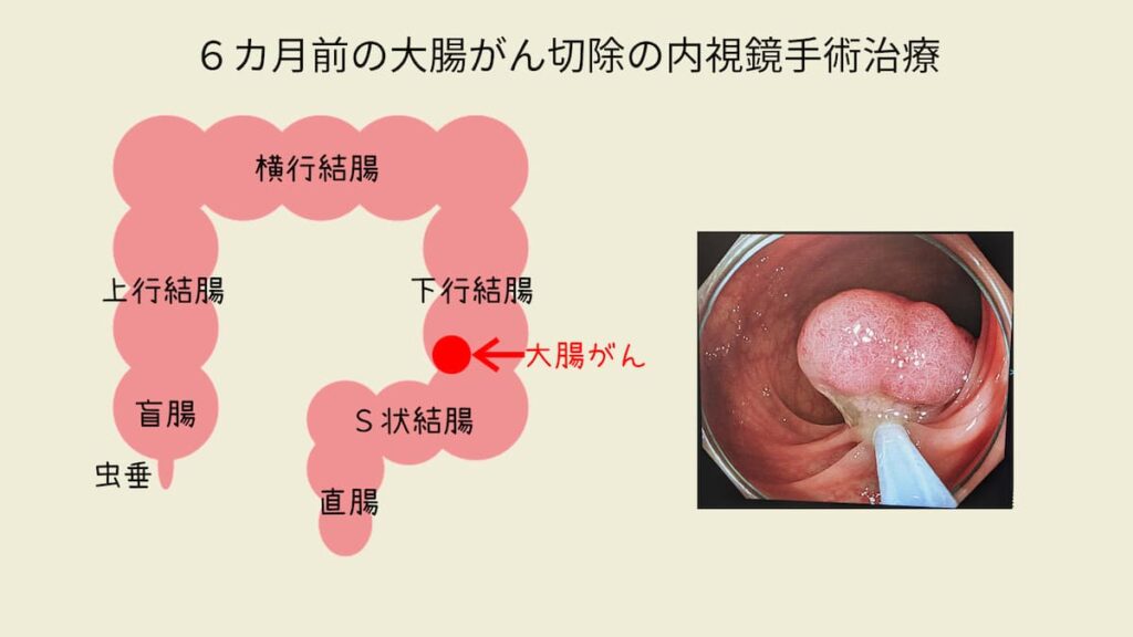 ６カ月前の大腸がん内視鏡手術治療