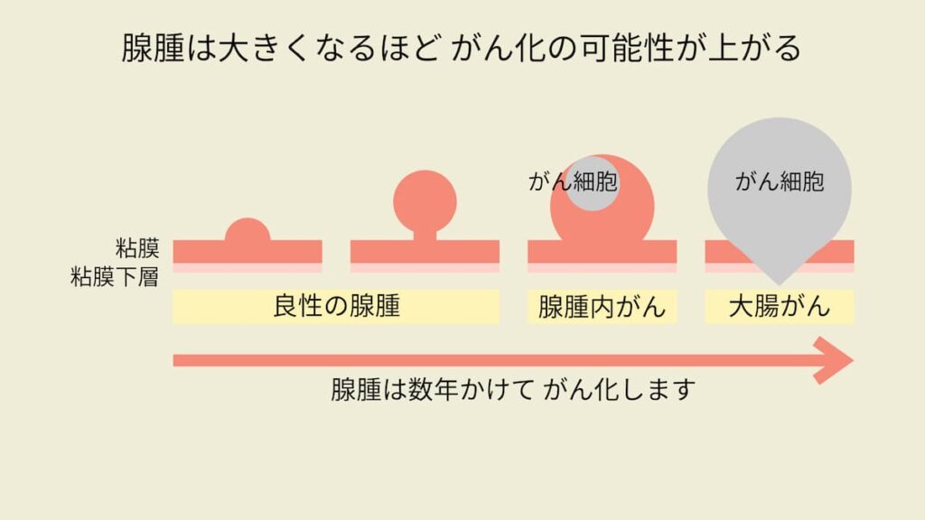 腺腫が大きくなるにつれて、腺腫内にがん細胞が発生し、大腸がんに成長