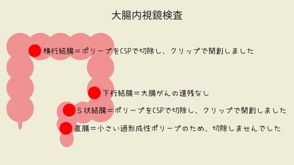 横行結腸とＳ状結腸のポリープをCSPで切除し、クリップで閉創しました