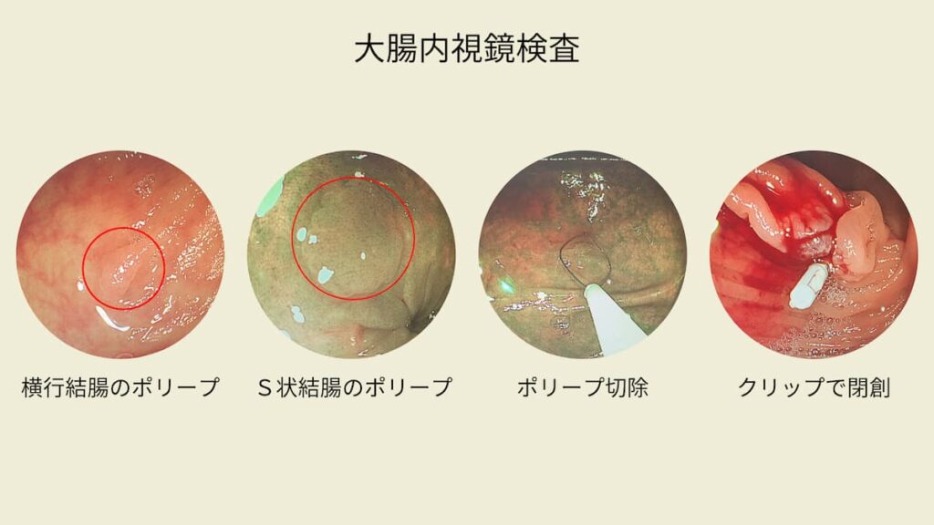 切除方法は、コールドポリペクトミー（CSP）