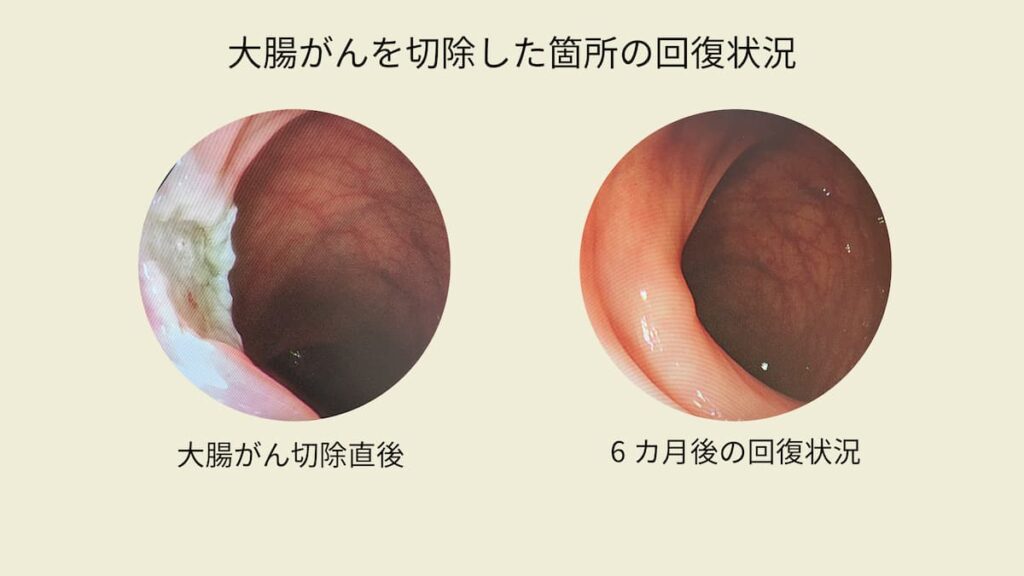 大腸がんを切除した箇所の回復状況